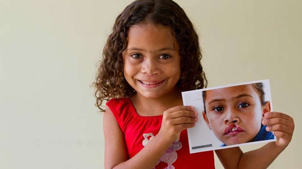 Dados da Organização Mundial da Saúde (OMS) mostram que uma em cada 650 crianças nasce com fissura lábio palatina no Brasil Foto: Shutterstock