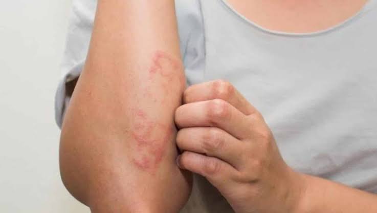Internet - Janeiro Roxo alerta sobre o combate e prevenção da hanseníase em Tupã
