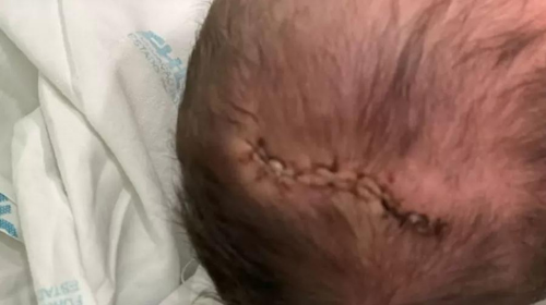 Olivia sofreu traumatismo craniano e precisou levar 11 pontos na cabeça após cair no chão durante parto