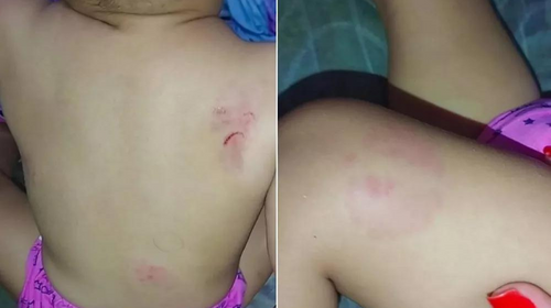 Menina tinha pelo menos oito mordidas pelo corpo, segundo a mãe, que registrou BO em Palmital — Foto: Arquivo pessoal