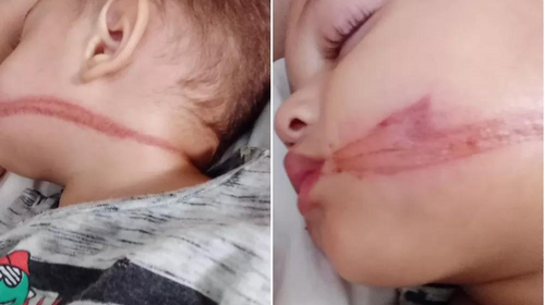 Bebês gêmeos são atingidos no rosto por  chicotada  de fiação solta em rua de Jaú — Foto: Arquivo pessoal