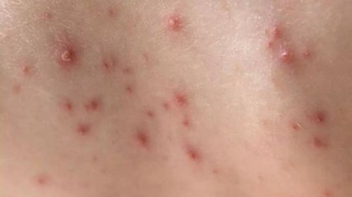 A catapora, também conhecida como varicela, causa inflamação visível na pele e surge principalmente no período da primavera e do verão — Foto: Getty Images via BBC